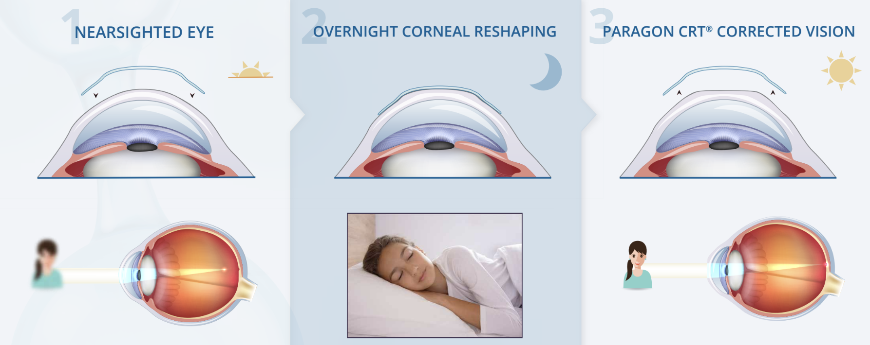 Orthokeratology - Cornea shaping night lens against myopia